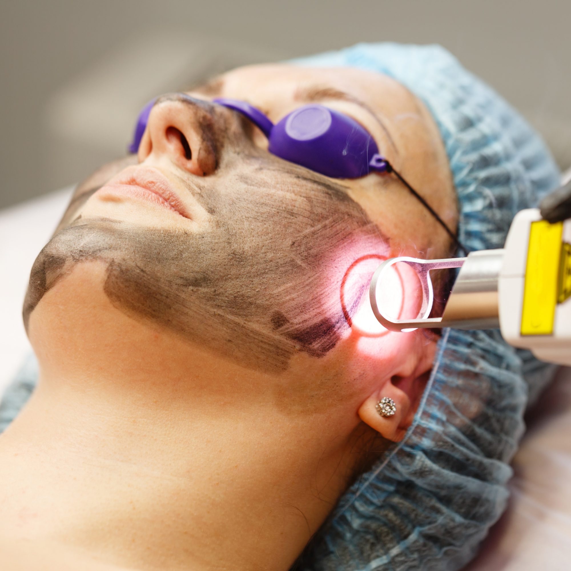 Carbon Whitening Laser