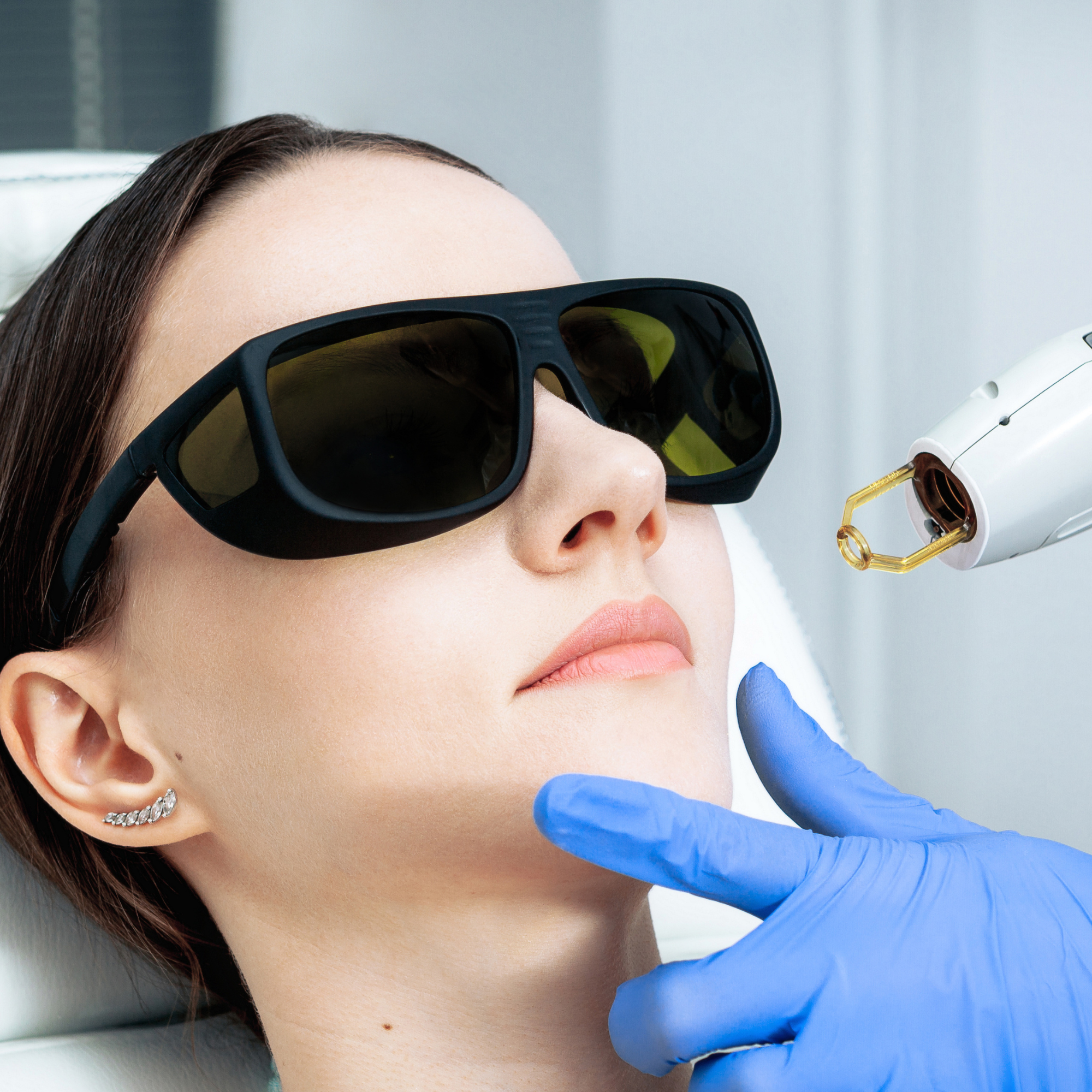 Laser For Pigmentation, Freckles, Sunspots