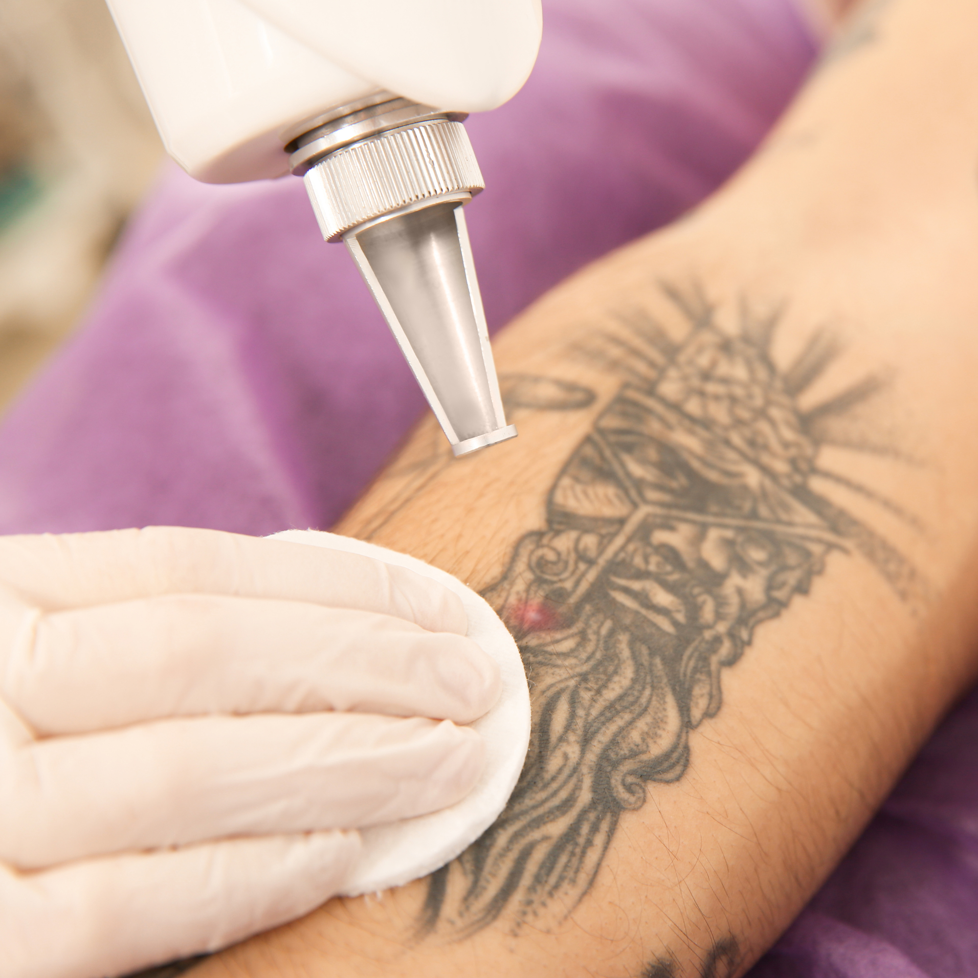 Laser Tattoo Removal