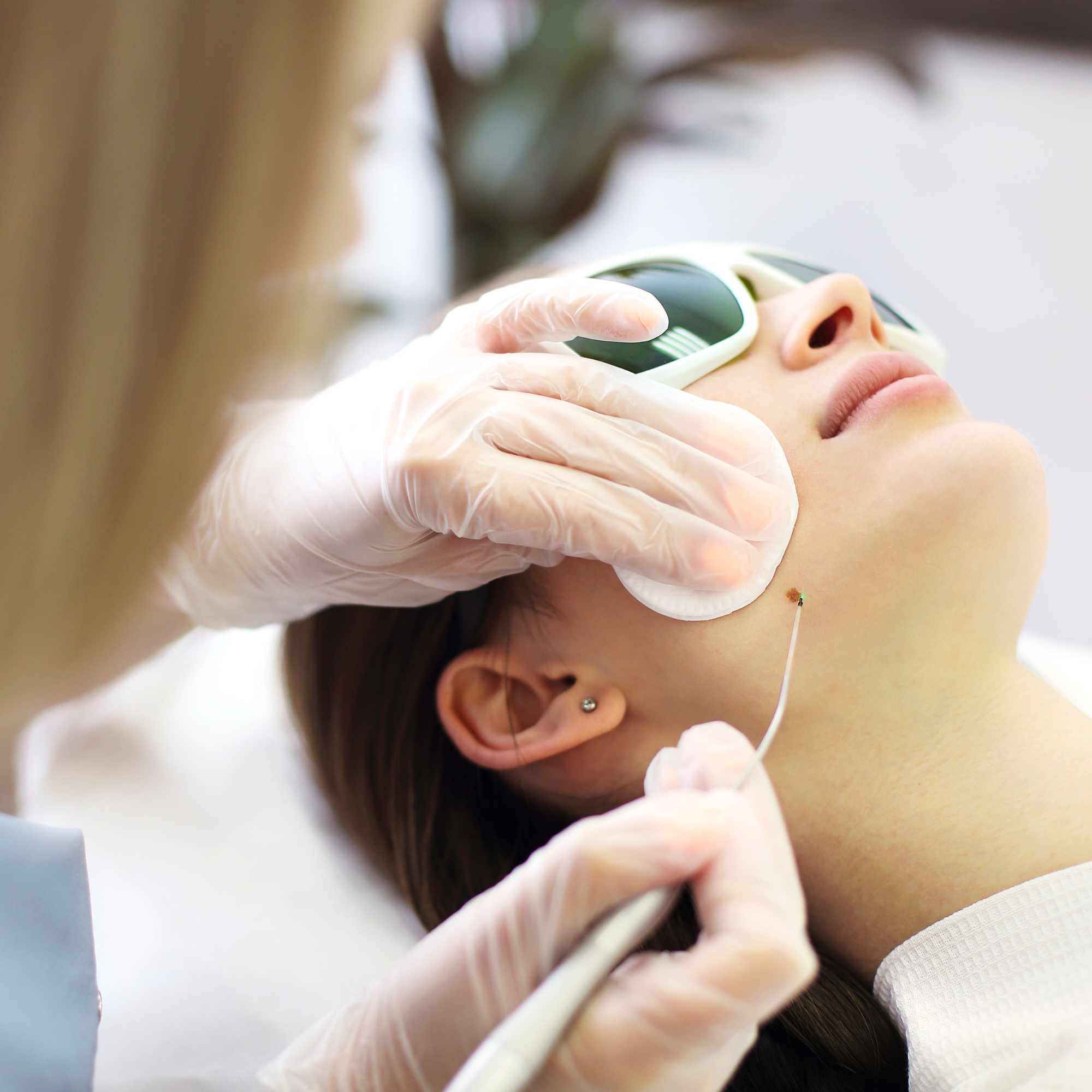 Skin Tag / Wart Removal