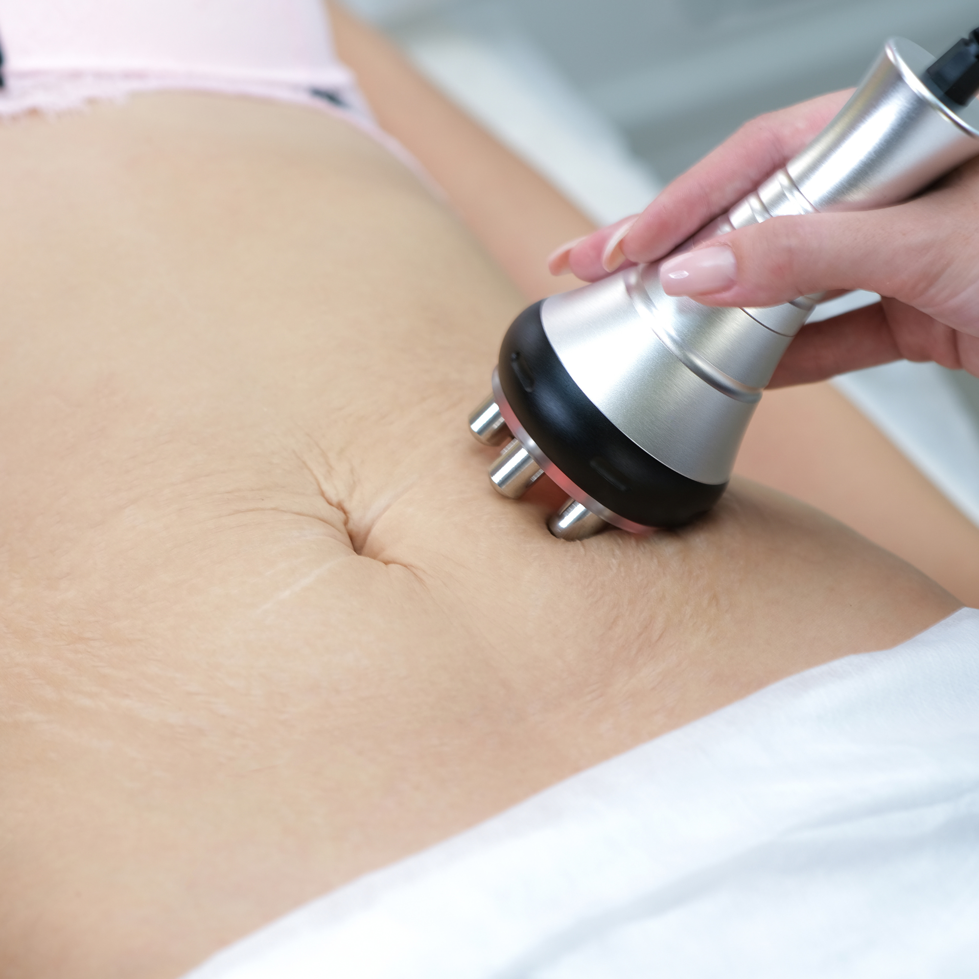 Stretch Mark Reduction